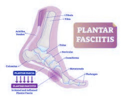 How to cure Plantar Fascitis in one week