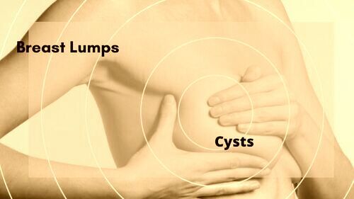 How to dissolve cysts in breast naturally