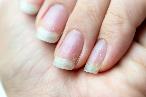 Brittle Nails- Signs of Iron Deficiency